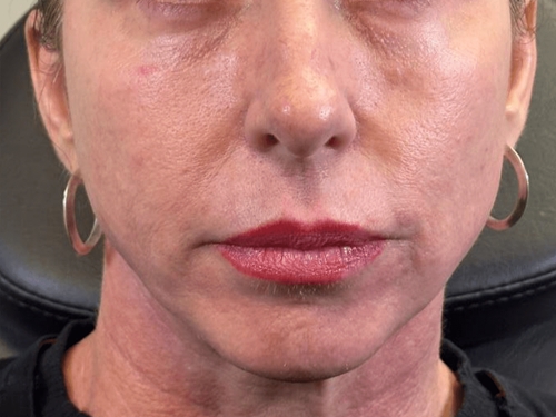 Before PRF injections showing under-eye hollows and dark circles at Arijia Med Spa.
