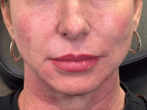 After PRF injection results showing improved under-eye volume and skin texture at Arijia Med Spa