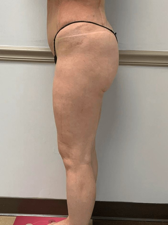 Before PermaFill buttock enhancement showing hip dips and volume loss – Arijia Med Spa.