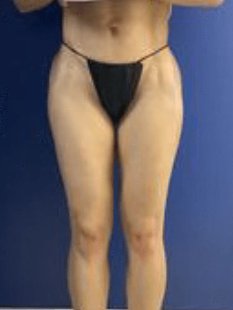 Baseline photo before PermaFill permanent filler injection at Arijia Med Spa.