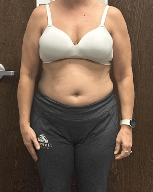 Medical weight loss before and after results showing total body transformation – Arijia Med Spa