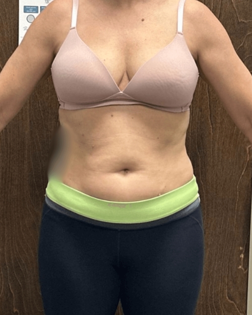Medical weight loss after results showing significant fat loss and body contouring at Arijia Med Spa.