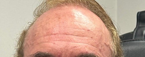 Before wrinkle relaxer injections showing active forehead lines and movement – Arijia Med Spa.