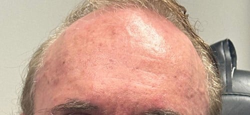 After wrinkle relaxer results showing smooth forehead skin and reduced lines – Arijia Med Spa.